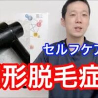 円形脱毛症の原因となる肺の機能低下やアレルギーとの繋がりを解説し、自宅でできる梅花鍼（ばいかしん）を使った頭皮ケアの強さや頻度を説明する石丸院長