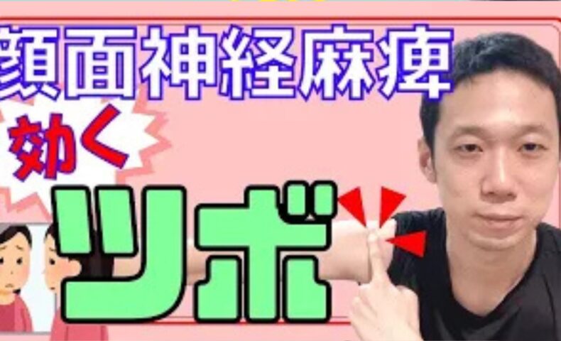 目が閉じない・口が歪むなどの顔面神経麻痺（ベル麻痺等）に対し、顔面部への血流と神経の回復を高めるため、肩にあるツボ「肩髃（けんぐ）」と首の横にある「扶突（ふとつ）」の位置とお灸（せんねん灸）を用いた1日3回の温活ケアを解説する石丸院長