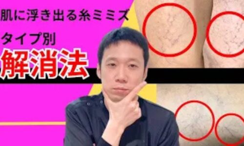 皮膚の浅い部分に現れる赤い糸ミミズのような毛細血管「細絡（さいらく）」と体内の血行不良「瘀血（おけつ）」を解消するために、運動習慣や湯船入浴、香味野菜や青魚を取り入れた生活改善法を解説する石丸院長